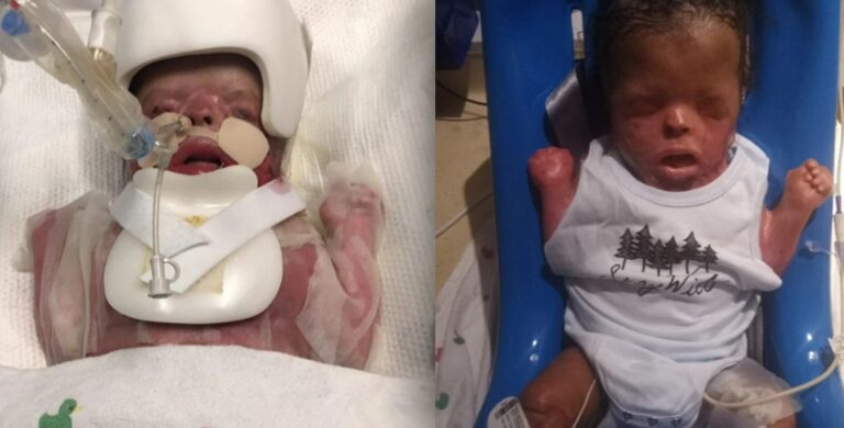 Baby Born Without Skin at 37 Weeks Receives Life-Saving Treatment