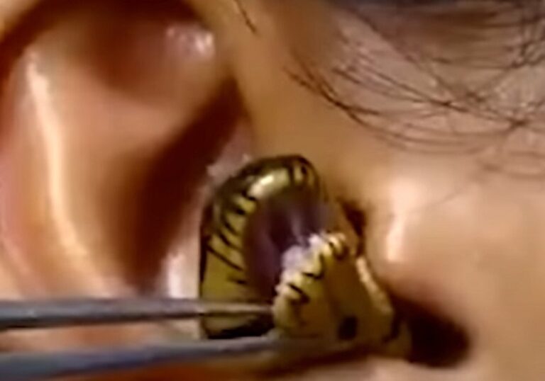 Doctor struggles to remove ‘live creature’ from woman’s ear in stunning video!