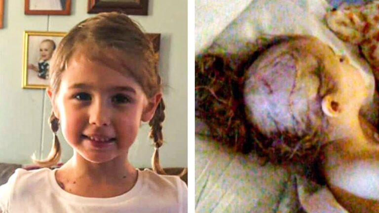 This Five Year Old Girl Was Scalped By A Go Kart, And Now Her Parents Are Warning Others