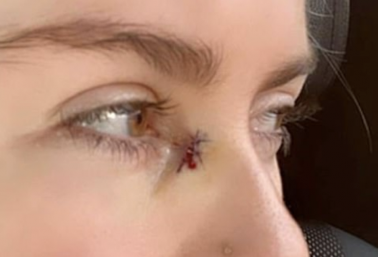 Woman thought it was just a pimple, but when the doctor saw it he gasped!