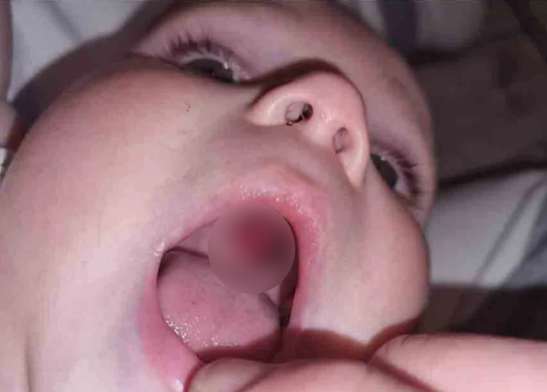 Mother rushed her baby to hospital thinking he has a hole in his mouth ‘only to discover the chilling truth’!