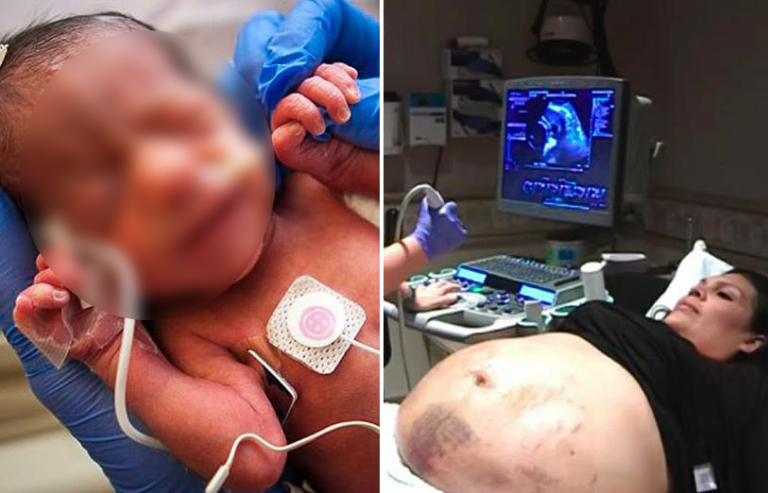 Pregnant woman showed up with bruises and marks on her belly, ‘then an ultrasound scan explained it all’!