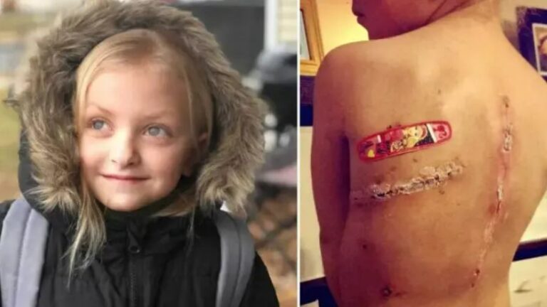 Brave Girl Beats Cancer But Kids Mock Her Scars – Fed-Up Mom Confronts Her Bullies