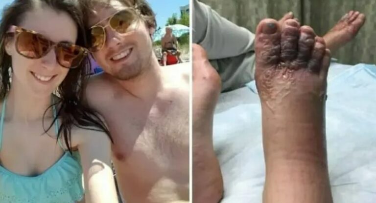 Couple Finds Worms In Their Feet After A Beach Vacation