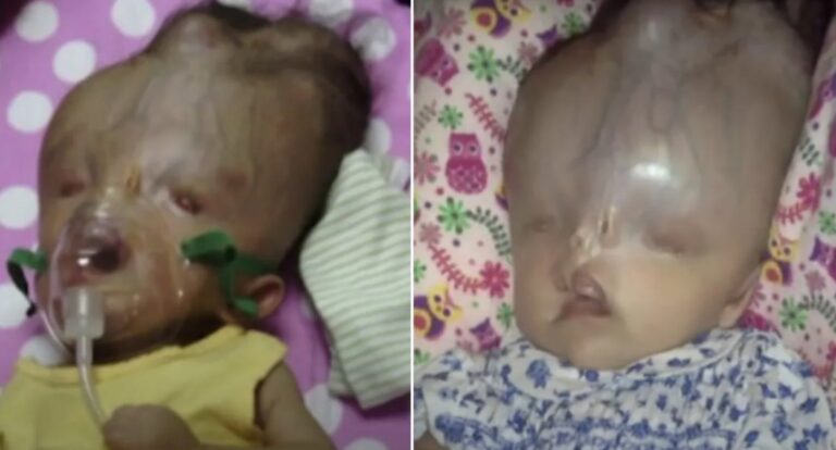 Baby defies odds after doctors advised her mom to abort due to defects ‘incompatible with life’ – This is how she looks like today