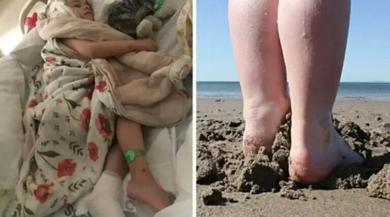 Toddler’s Unfortunate Beach Accident Left The Skin On Her Foot ‘Falling Off’